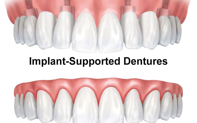 Traditional vs. Implant-supported Dentures