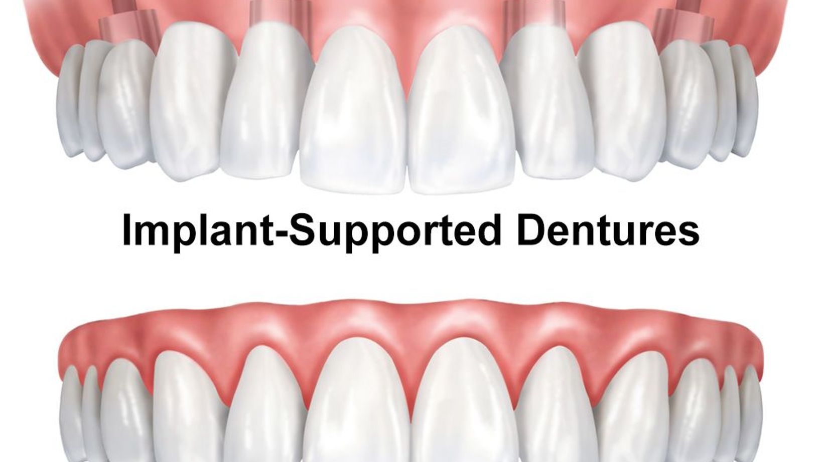 Traditional vs. Implant-supported Dentures
