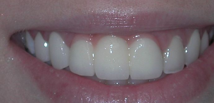 Dental Crowns: Case 24 — after