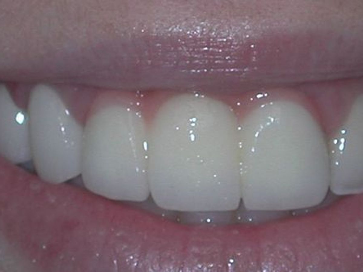 Dental Crowns: Case 24 — after