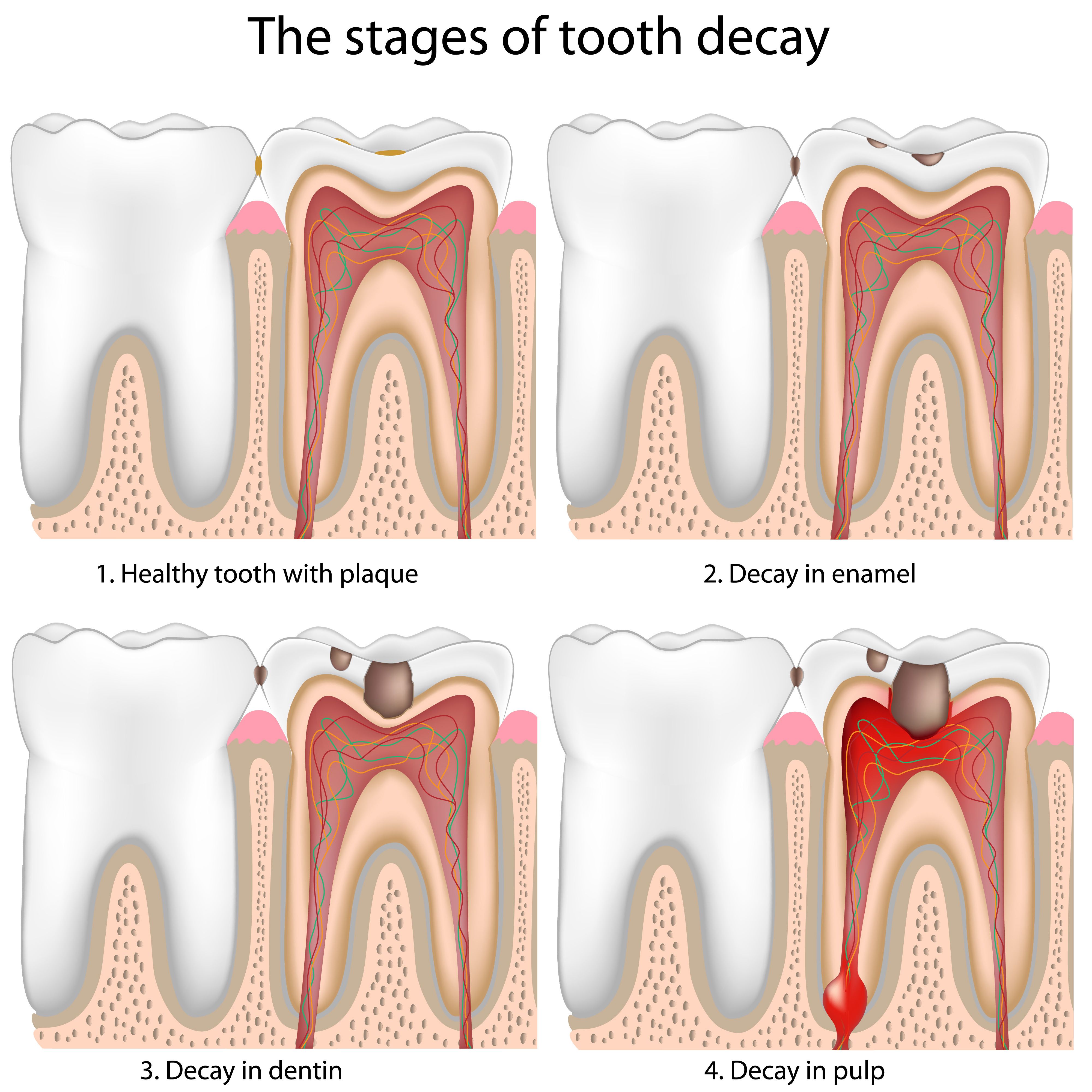 The Five Stages of Tooth Decay