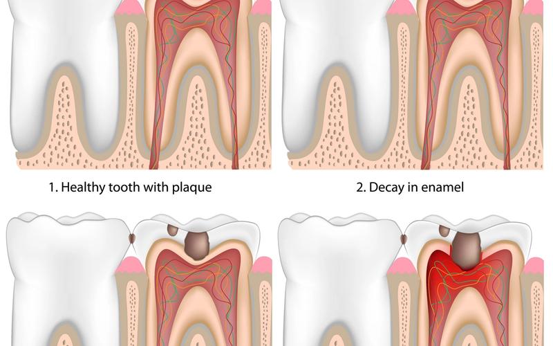 The Five Stages of Tooth Decay