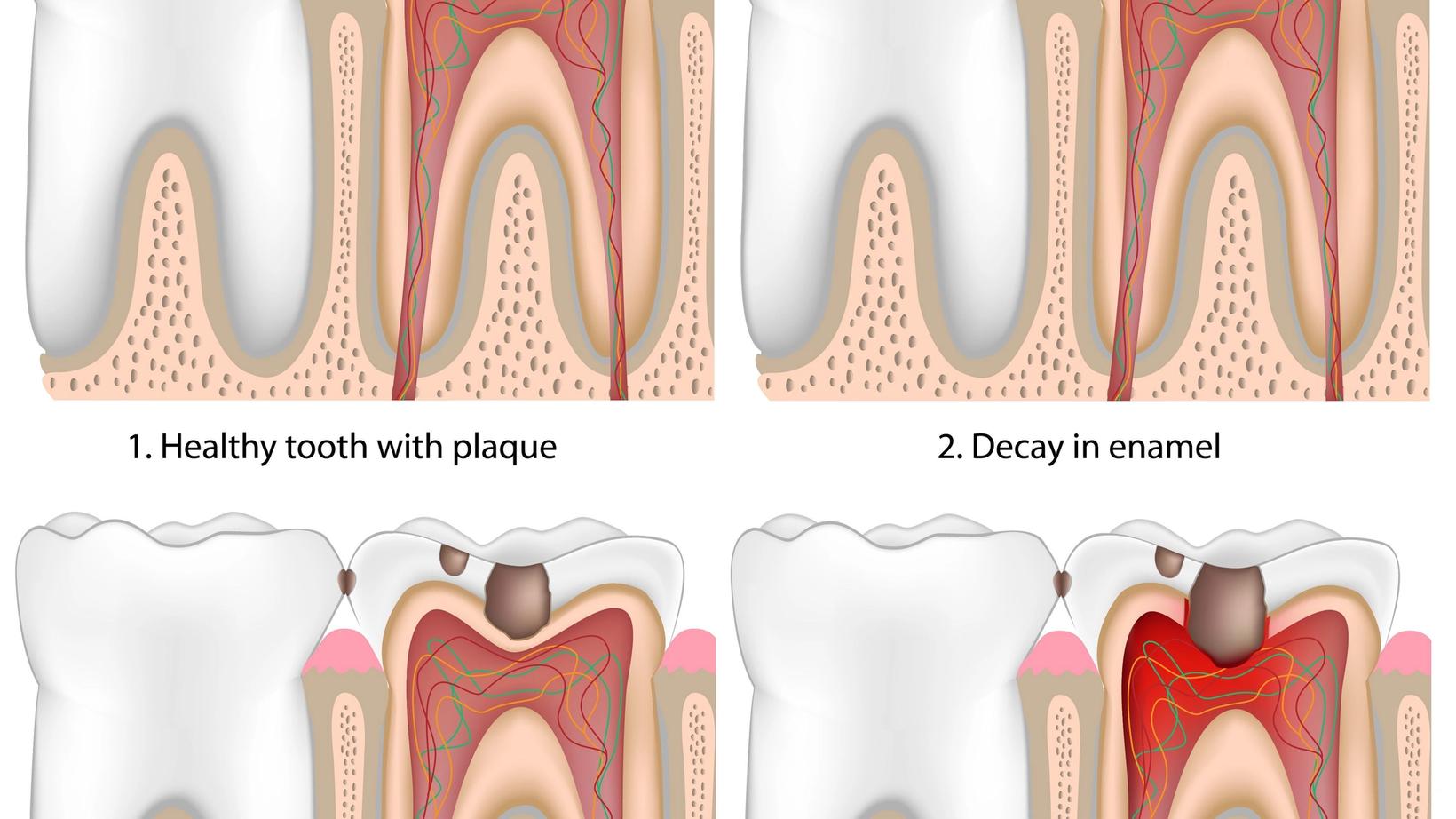 The Five Stages of Tooth Decay