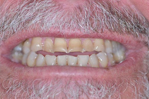 Dental Crowns: Case 15 — before