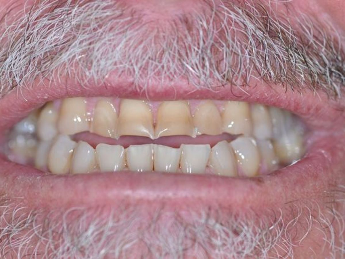 Dental Crowns: Case 15 — before