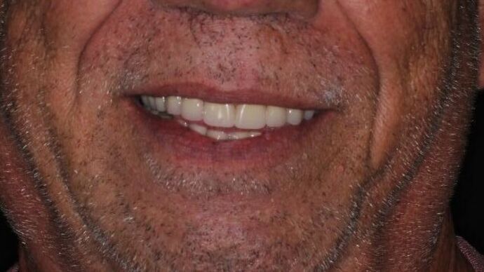 Dental Implants: Case 11 — after
