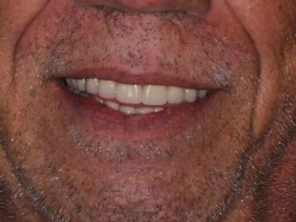 Dental Implants: Case 11 — after