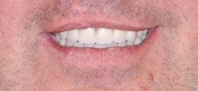 Teeth in a Day: Case 12 — Upper Arch before