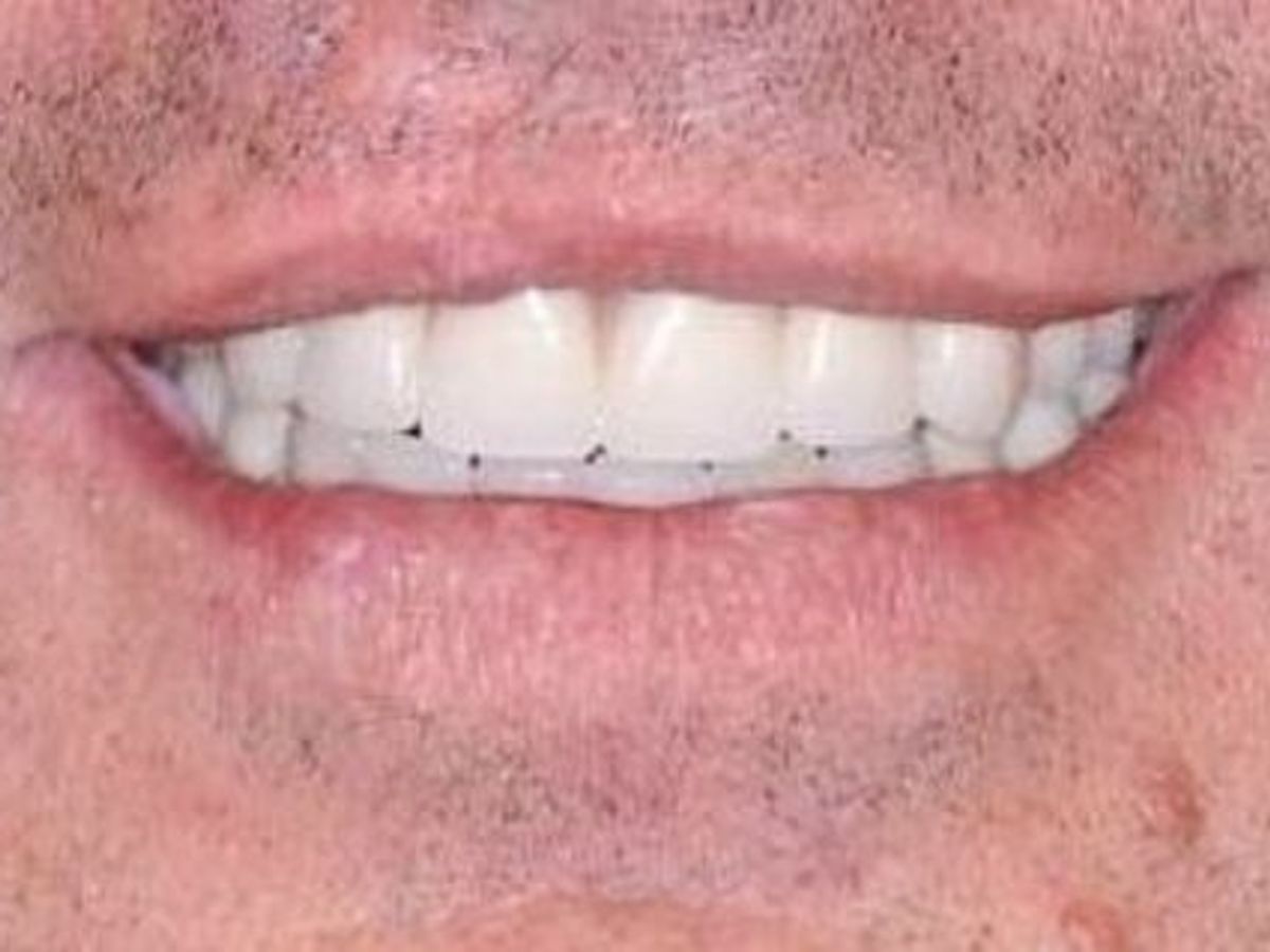 Teeth in a Day: Case 12 — Upper Arch before