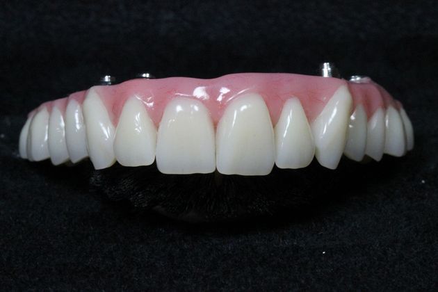 Teeth in a Day: Case 20 — Final Upper Restoration / Final Restoration after