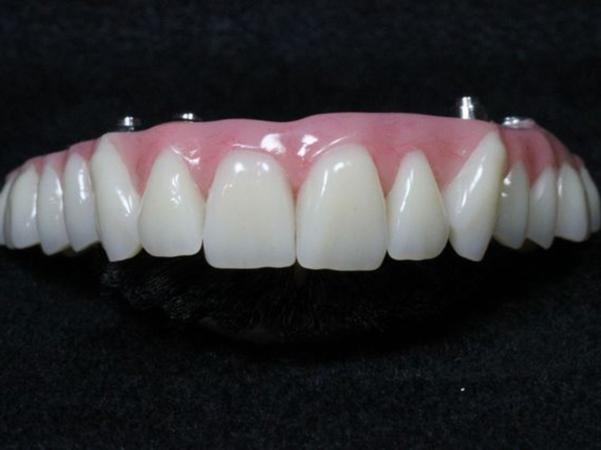 Teeth in a Day: Case 20 — Final Upper Restoration / Final Restoration after