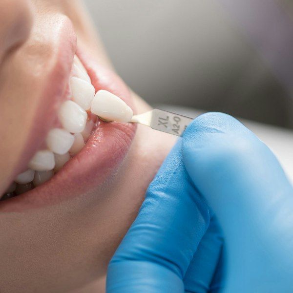 Woman receiving veneer