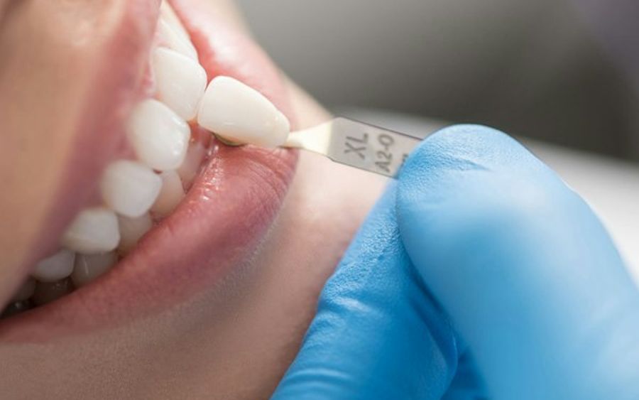 Woman receiving veneer
