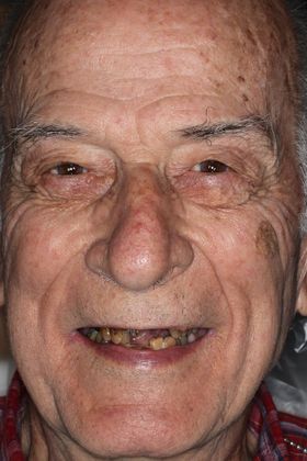Dentures: Case 8 — before