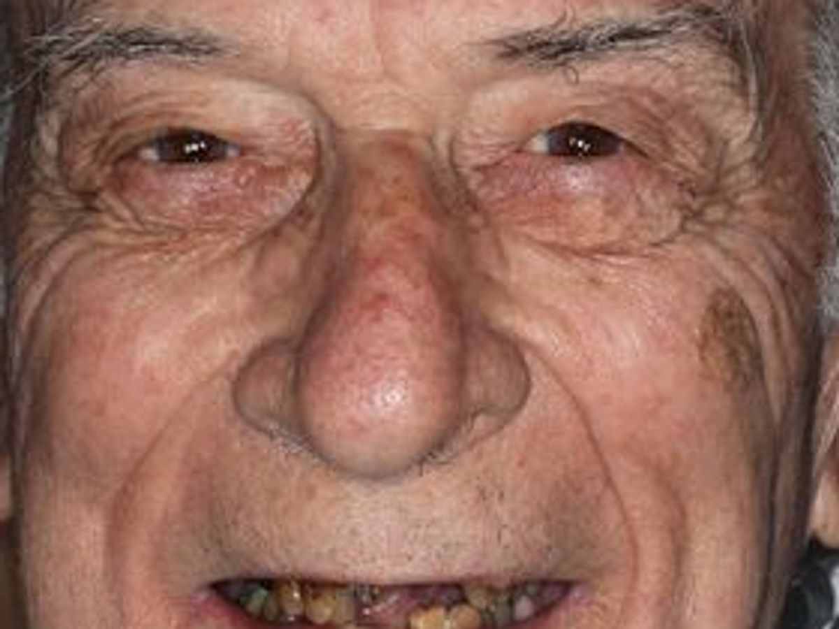 Dentures: Case 8 — before