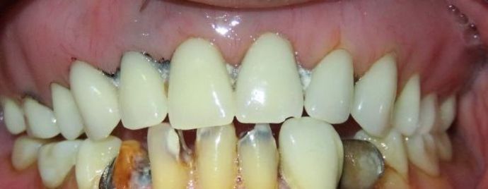 Teeth in a Day: Case 19 — before