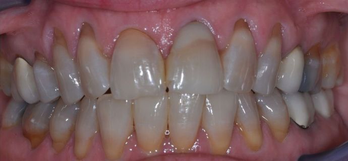 Veneers: Case 11 — before