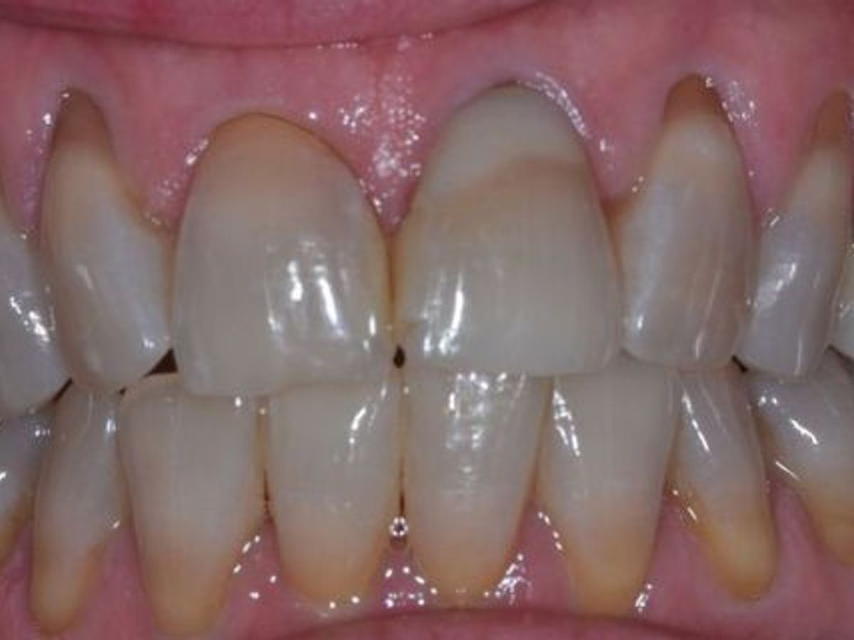Veneers: Case 11 — before