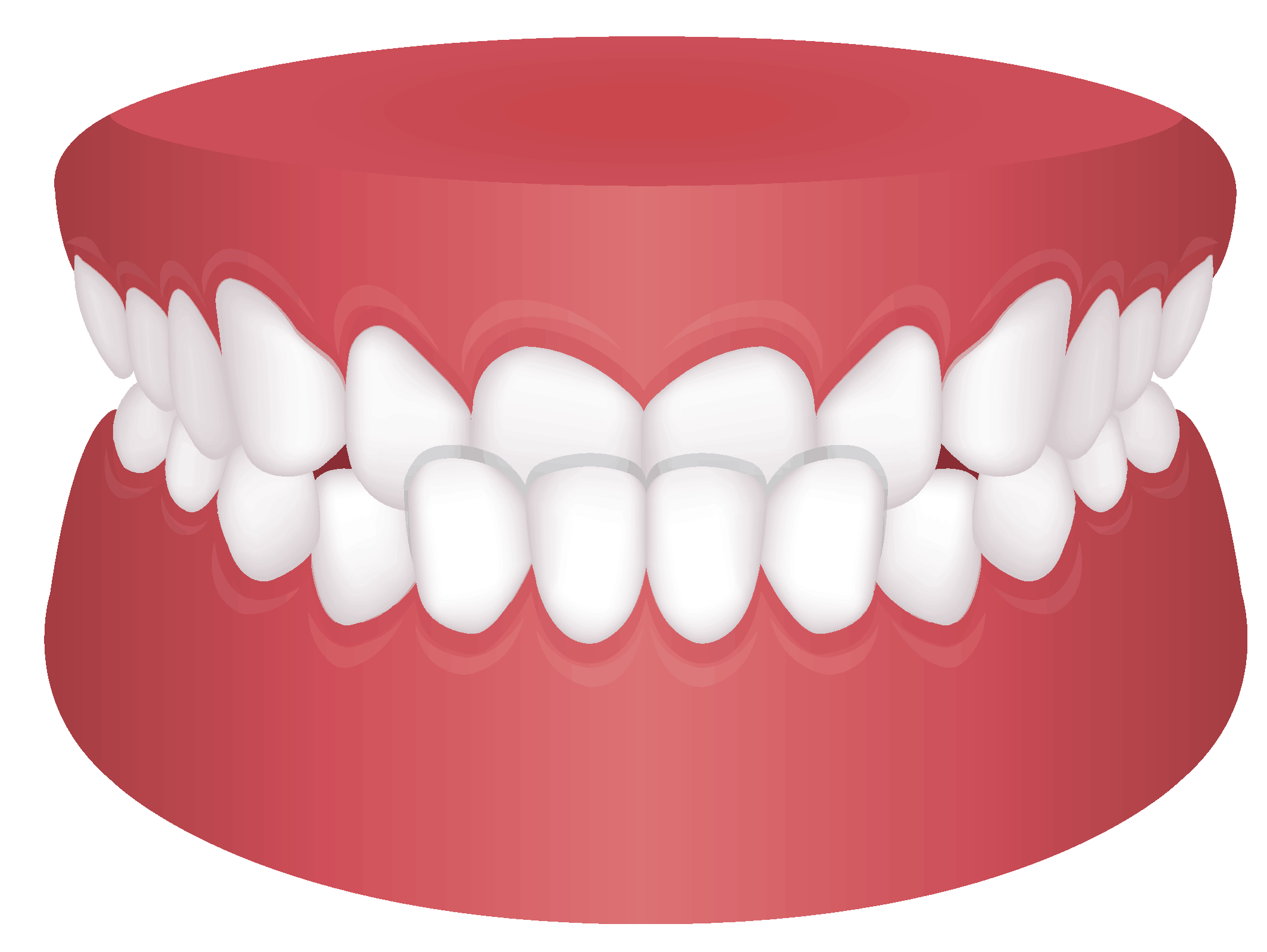 visual diagram of underbite