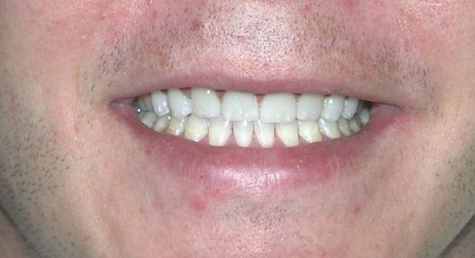 Veneers: Case 15 — after