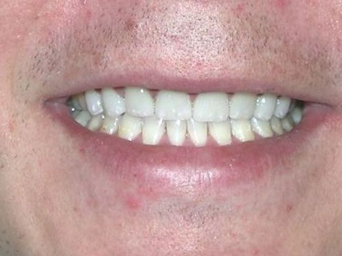 Veneers: Case 15 — after