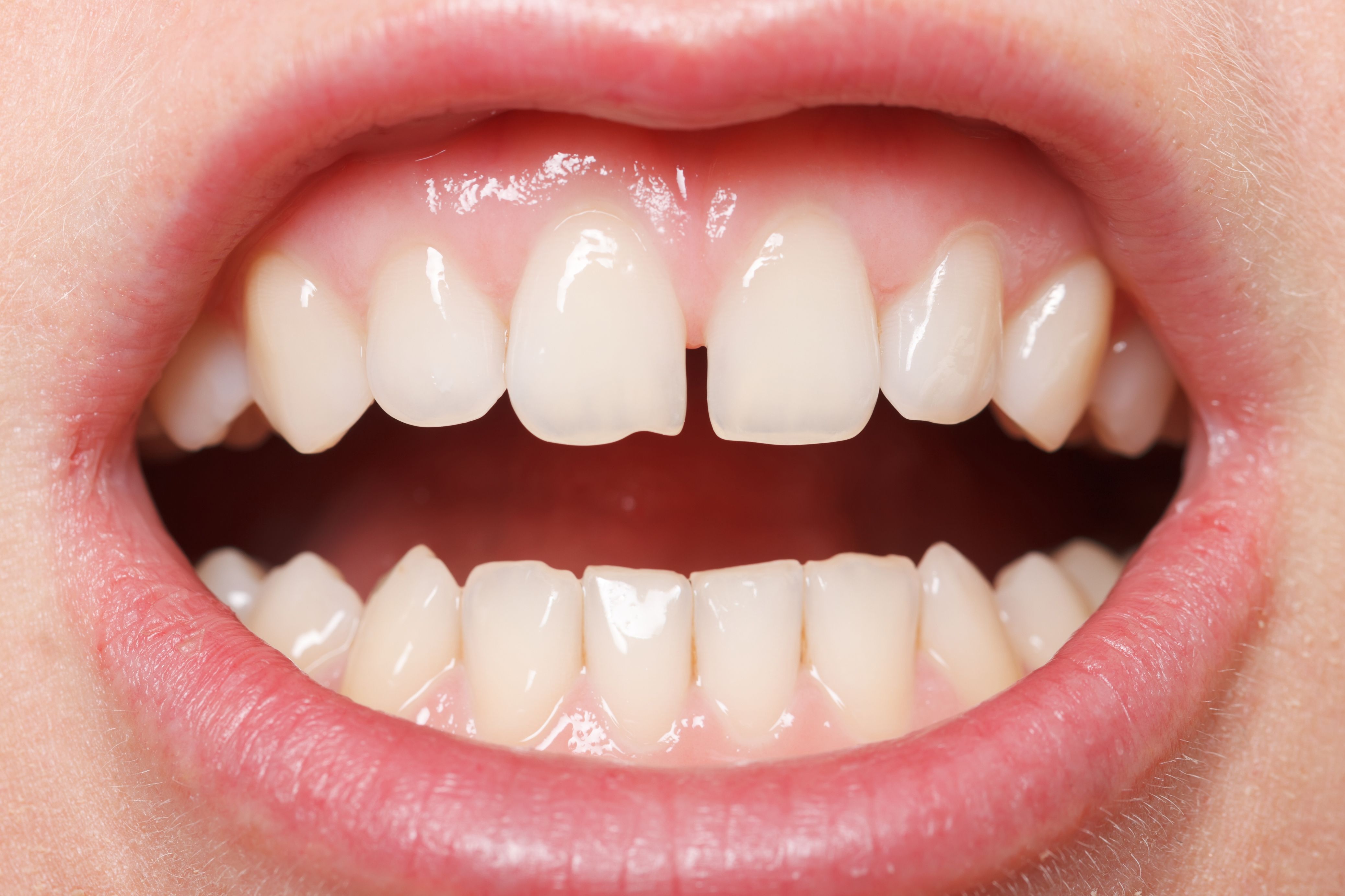 Are You a Good Candidate for Cosmetic Dental Bonding?