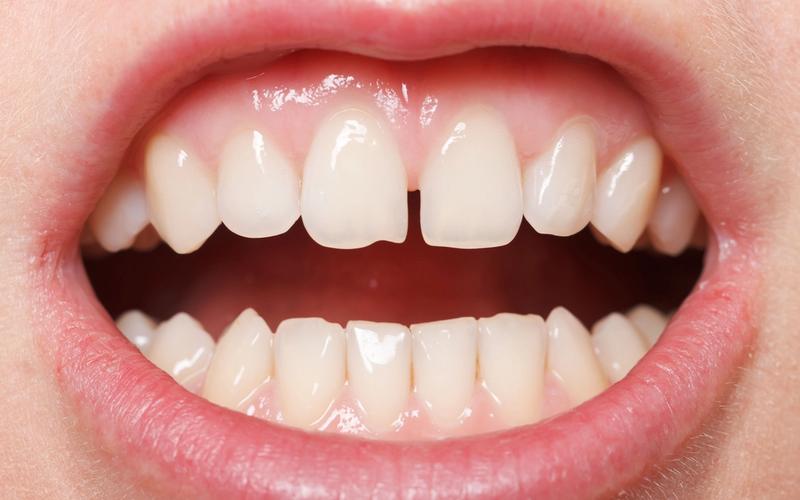 Are You a Good Candidate for Cosmetic Dental Bonding?