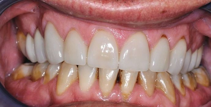 Dental Crowns: Case 11 — after