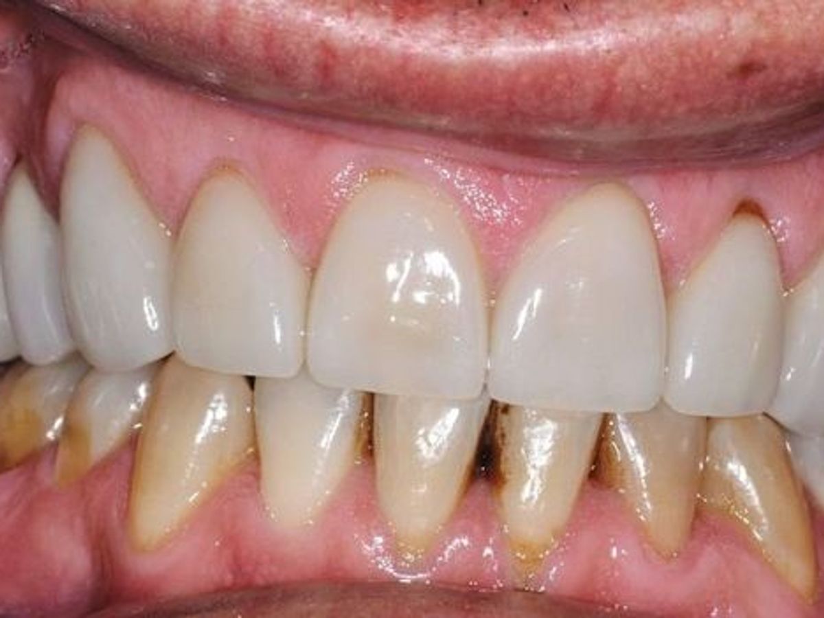 Dental Crowns: Case 11 — after