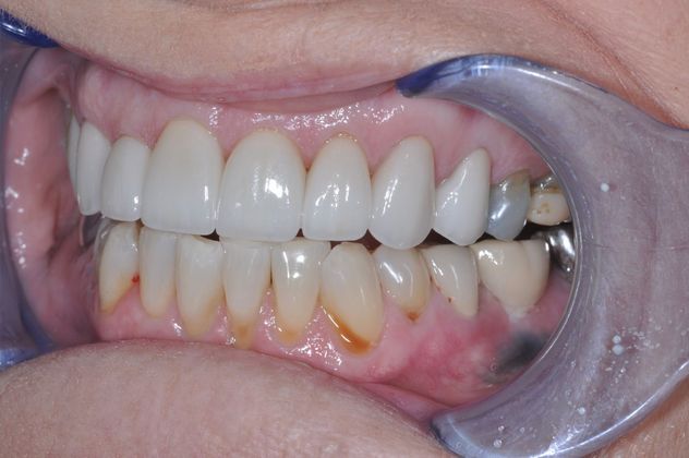 Dental Crowns: Case 3 — after