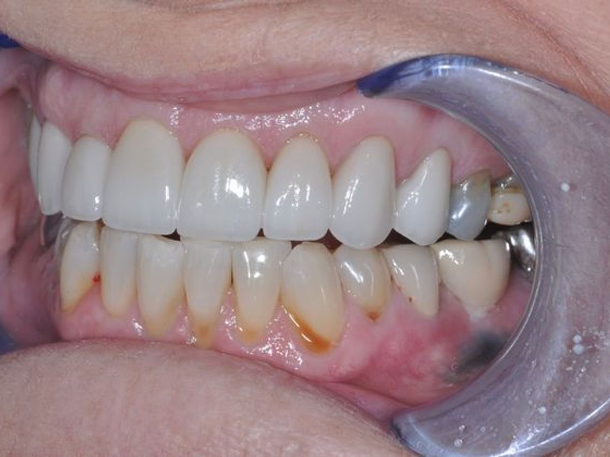 Dental Crowns: Case 3 — after