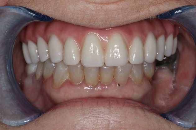 Teeth in a Day: Case 5 — Upper Arch before