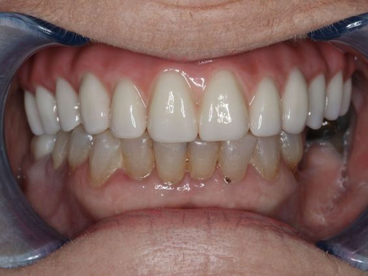 Teeth in a Day: Case 5 — Upper Arch before