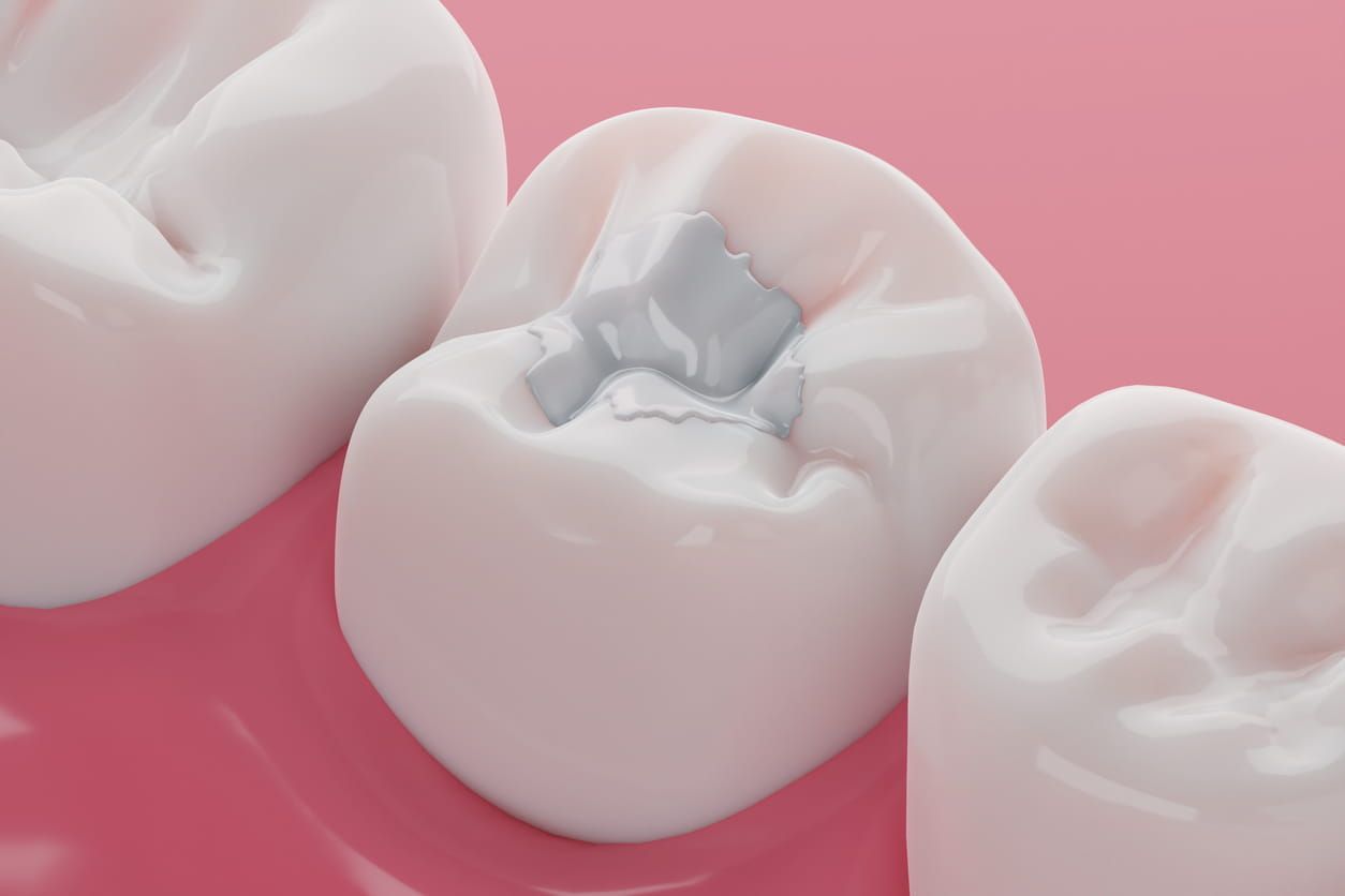 Close-up of tooth with a tooth-colored filling