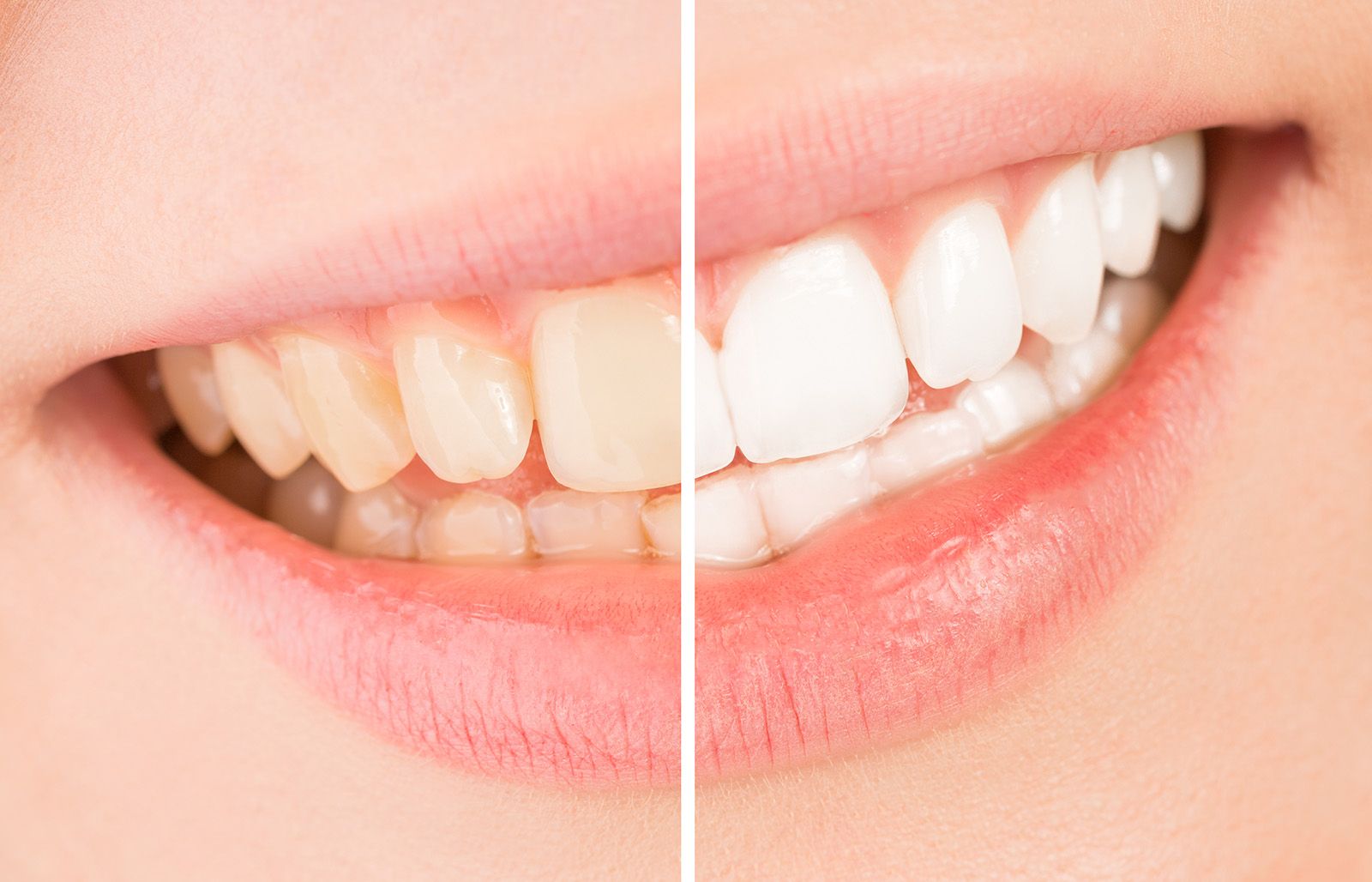 Can I Drink Coffee after Teeth Whitening?