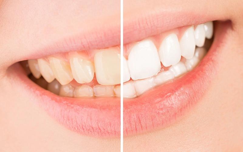 Can I Drink Coffee after Teeth Whitening?