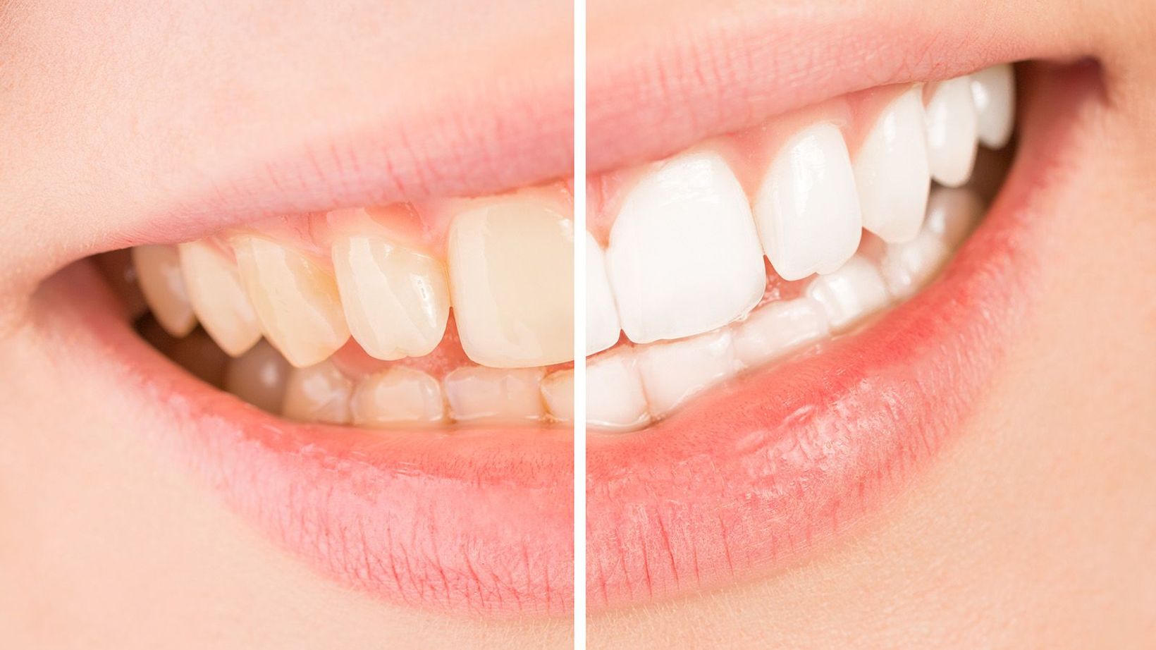 Can I Drink Coffee after Teeth Whitening?