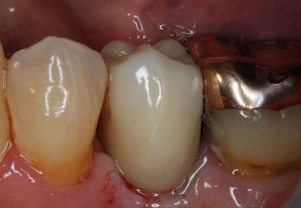 Dental Implants: Case 4 — after
