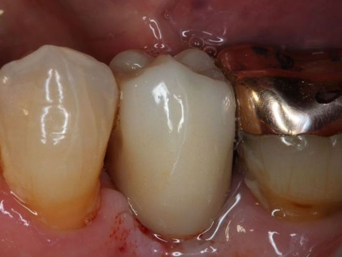Dental Implants: Case 4 — after