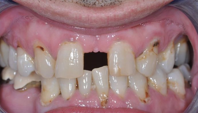 Dental Crowns: Case 23 — before