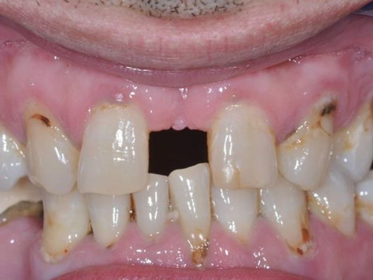 Dental Crowns: Case 23 — before