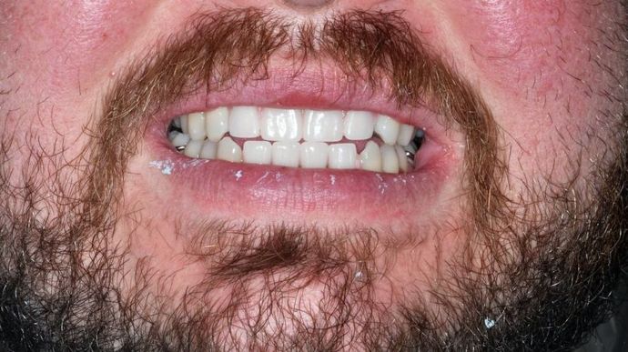 Dental Crowns: Case 23 — after