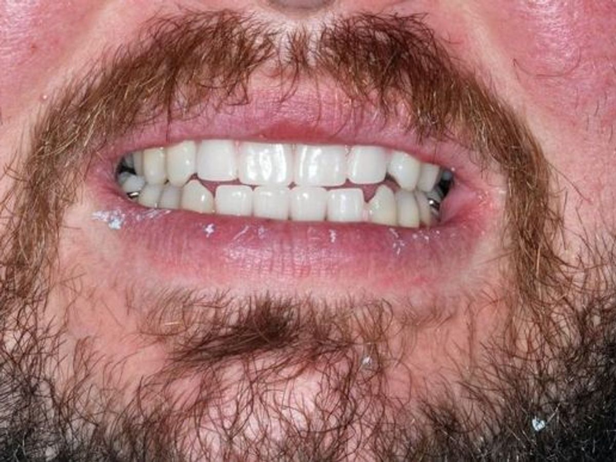 Dental Crowns: Case 23 — after