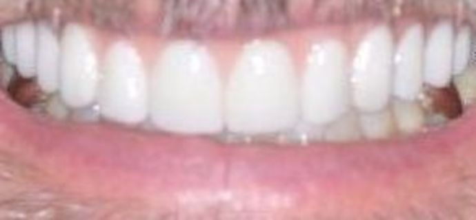 Teeth in a Day: Case 21 — Upper Prosthetic before