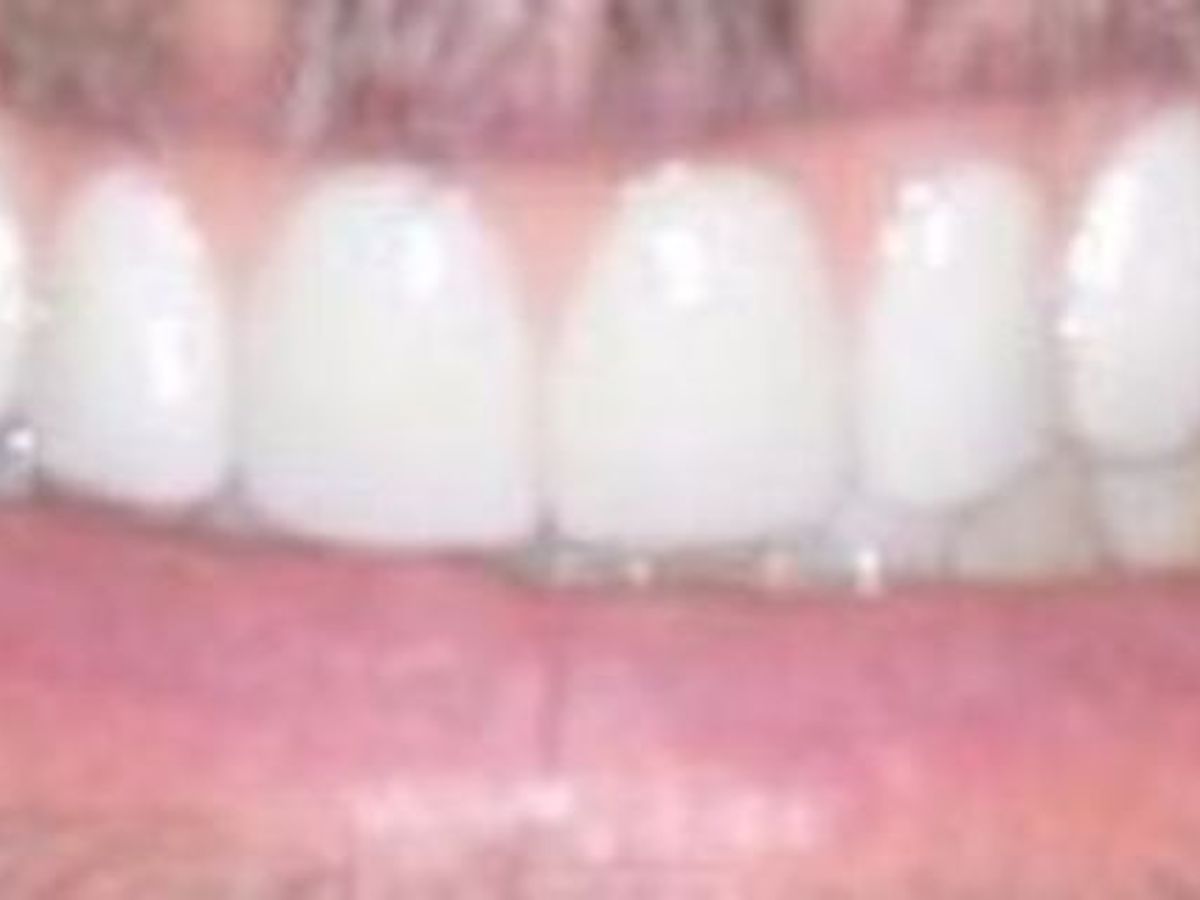 Teeth in a Day: Case 21 — Upper Prosthetic before