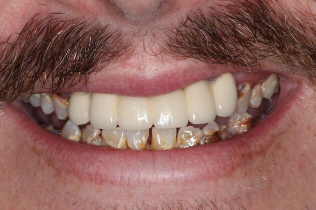 Dental Implants: Case 13 — Lower Locator Denture before