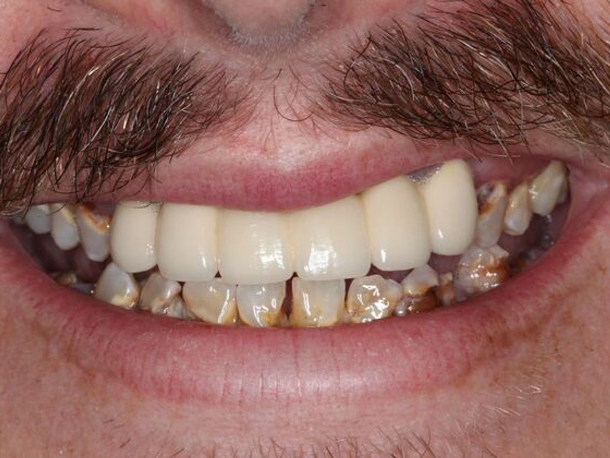 Dental Implants: Case 13 — Lower Locator Denture before