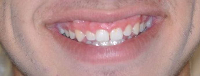 Gum Lift: Case 5 — before
