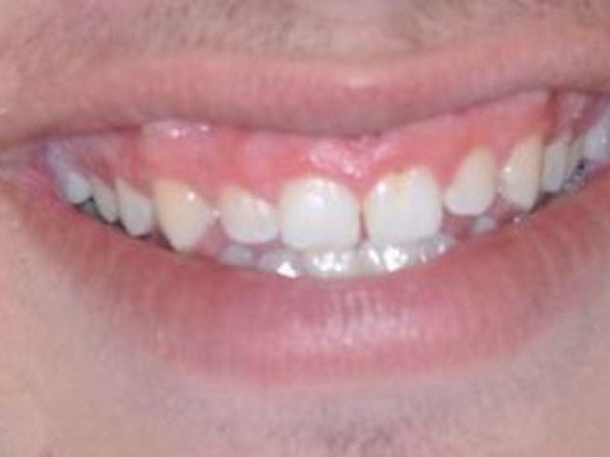 Gum Lift: Case 5 — before