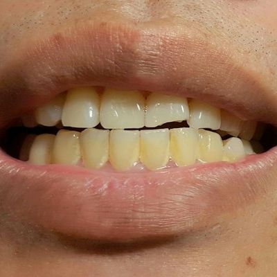 Person with discolored teeth